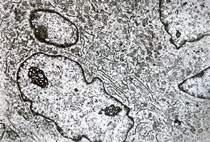 F,25y. | giant multinuclear osteoclast - aneurysmatic cyst - tibia F,25y. | giant multinuclear osteoclast - aneurysmatic cyst - tibia